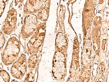 WDR33 Antibody - Immunohistochemistry of paraffin-embedded Human liver cancer tissue  using WDR33 Polyclonal Antibody at dilution of 1:65(×200)