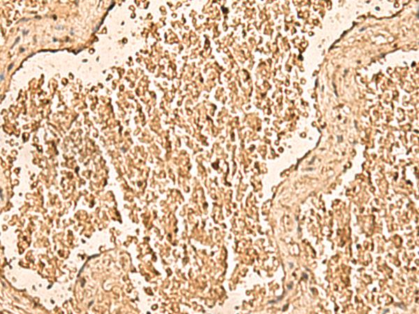 WDR33 Antibody - Immunohistochemistry of paraffin-embedded Human gastric cancer tissue  using WDR33 Polyclonal Antibody at dilution of 1:50(×200)