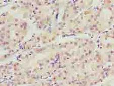 WDR34 Antibody - Immunohistochemistry of paraffin-embedded human gastric cancer using antibody at dilution of 1:100.