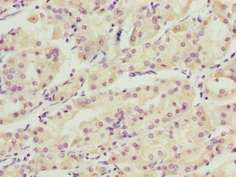 WDR34 Antibody - Immunohistochemistry of paraffin-embedded human gastric cancer using WDR34 Antibody at dilution of 1:100