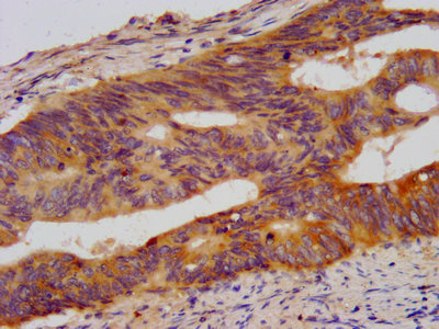 WDR37 Antibody - IHC image of Wdr37 Antibody diluted at 1:500 and staining in paraffin-embedded human colon cancer performed on a Leica BondTM system. After dewaxing and hydration, antigen retrieval was mediated by high pressure in a citrate buffer (pH 6.0). Section was blocked with 10% normal goat serum 30min at RT. Then primary antibody (1% BSA) was incubated at 4°C overnight. The primary is detected by a biotinylated secondary antibody and visualized using an HRP conjugated SP system.