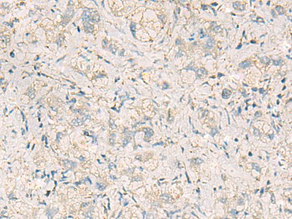 WDR37 Antibody - Immunohistochemistry of paraffin-embedded Human liver cancer tissue  using WDR37 Polyclonal Antibody at dilution of 1:50(×200)