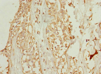 WDR38 Antibody - Immunohistochemistry of paraffin-embedded human breast cancer at dilution 1:100