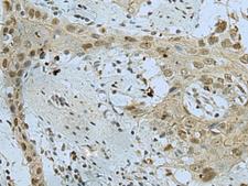 WDR4 Antibody - Immunohistochemistry of paraffin-embedded Human esophagus cancer tissue  using WDR4 Polyclonal Antibody at dilution of 1:40(×200)