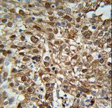 WDR43 Antibody - WDR43 Antibody immunohistochemistry of formalin-fixed and paraffin-embedded human Cervix carcinoma followed by peroxidase-conjugated secondary antibody and DAB staining.