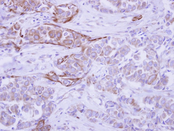 WDR49 Antibody - IHC of paraffin-embedded Breast ca, using WDR49 antibody antibody at 1:500 dilution.