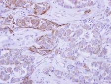 WDR49 Antibody - IHC of paraffin-embedded Breast ca, using WDR49 antibody antibody at 1:500 dilution.