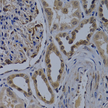 WDR5 Antibody - Immunohistochemistry of paraffin-embedded human kidney cancer tissue.
