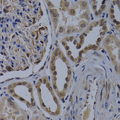 WDR5 Antibody - Immunohistochemistry of paraffin-embedded human kidney cancer tissue.