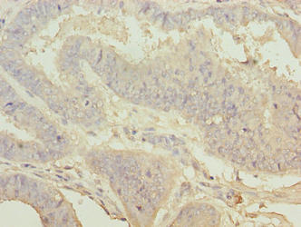 WDR53 Antibody - Immunohistochemistry of paraffin-embedded human endometrial cancer using WDR53 Antibody at dilution of 1:100