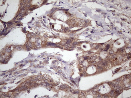 WDR61 Antibody - Immunohistochemical staining of paraffin-embedded Adenocarcinoma of Human breast tissue using anti-WDR61 mouse monoclonal antibody. (Heat-induced epitope retrieval by 1 mM EDTA in 10mM Tris, pH8.5, 120C for 3min. (1:150)