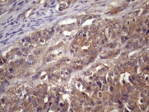 WDR61 Antibody - Immunohistochemical staining of paraffin-embedded Adenocarcinoma of Human colon tissue using anti-WDR61 mouse monoclonal antibody. (Heat-induced epitope retrieval by 1 mM EDTA in 10mM Tris, pH8.5, 120C for 3min. (1:150)
