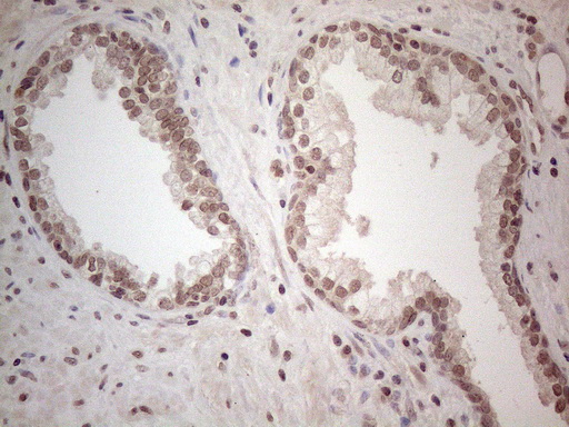 WDR61 Antibody - Immunohistochemical staining of paraffin-embedded Carcinoma of Human prostate tissue using anti-WDR61 mouse monoclonal antibody. (Heat-induced epitope retrieval by 1mM EDTA in 10mM Tris buffer. (pH8.5) at 120°C for 3 min. (1:150)