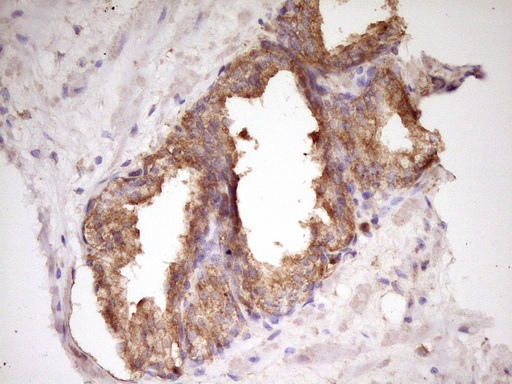 WDR61 Antibody - Immunohistochemical staining of paraffin-embedded Carcinoma of Human prostate tissue using anti-WDR61 mouse monoclonal antibody. (Heat-induced epitope retrieval by 1 mM EDTA in 10mM Tris, pH8.5, 120C for 3min,