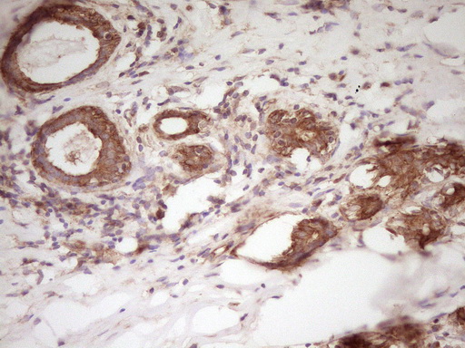 WDR61 Antibody - Immunohistochemical staining of paraffin-embedded Carcinoma of Human kidney tissue using anti-WDR61 mouse monoclonal antibody. (Heat-induced epitope retrieval by 1 mM EDTA in 10mM Tris, pH8.5, 120C for 3min,