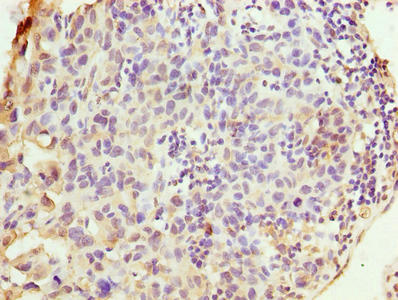 WDR62 Antibody - Immunohistochemistry of paraffin-embedded human bladder cancer using WDR62 Antibody at dilution of 1:100