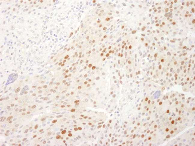 WDR77 / MEP50 Antibody - Detection of Human WDR77/MEP50 by Immunohistochemistry. Sample: FFPE section of human pancreatic islet cell tumor. Antibody: Affinity purified rabbit anti-WDR77/MEP50 used at a dilution of 1:5000 (0.2 ug/ml). Detection: DAB.