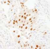 WDR77 / MEP50 Antibody - Detection of Human WDR77/MEP50 by Immunohistochemistry. Sample: FFPE section of human pancreatic islet cell tumor. Antibody: Affinity purified rabbit anti-WDR77/MEP50 used at a dilution of 1:1000 (0.2 ug/ml). Detection: DAB.