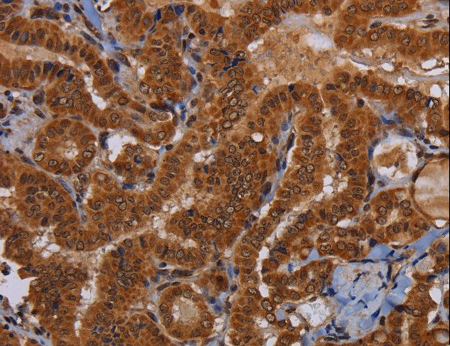 WDR83 Antibody - Immunohistochemistry of paraffin-embedded Human colon cancer using WDR83 Polyclonal Antibody at dilution of 1:60.