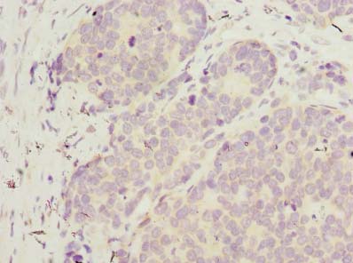 WDR89 Antibody - Immunohistochemistry of paraffin-embedded human gastric cancer using antibody at dilution of 1:100.