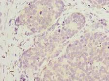WDR89 Antibody - Immunohistochemistry of paraffin-embedded human gastric cancer using antibody at dilution of 1:100.