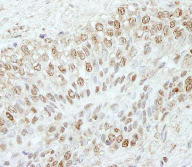 WDR91 Antibody - Detection of Human WDR91 by Immunohistochemistry. Sample: FFPE section of human prostate carcinoma. Antibody: Affinity purified rabbit anti-WDR91 used at a dilution of 1:250.