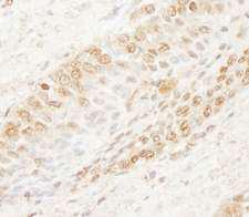 WDR91 Antibody - Detection of Human WDR91 by Immunohistochemistry. Sample: FFPE section of human prostate carcinoma. Antibody: Affinity purified rabbit anti-WDR91 used at a dilution of 1:1000 (1 ug/ml). Detection: DAB.