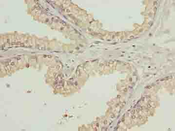 WDR91 Antibody - Immunohistochemistry of paraffin-embedded human prostate cancer using antibody at dilution of 1:100.