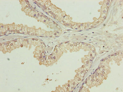 WDR91 Antibody - Immunohistochemistry of paraffin-embedded human prostate cancer using WDR91 Antibody at dilution of 1:100