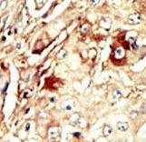 WEE1 Antibody - Formalin-fixed and paraffin-embedded human cancer tissue reacted with the primary antibody, which was peroxidase-conjugated to the secondary antibody, followed by AEC staining. This data demonstrates the use of this antibody for immunohistochemistry; clinical relevance has not been evaluated. BC = breast carcinoma; HC = hepatocarcinoma.