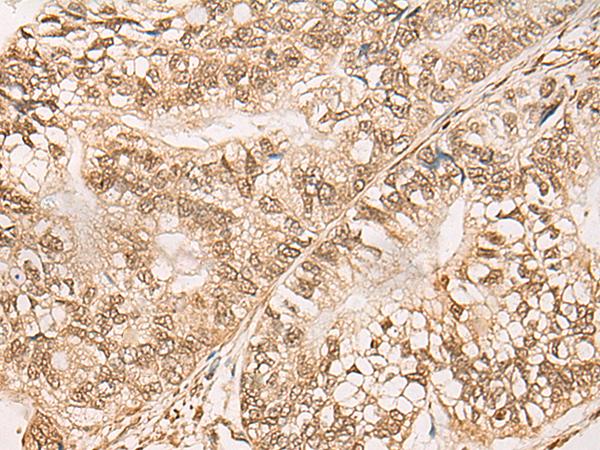WEE1 Antibody - Immunohistochemistry of paraffin-embedded Human gastric cancer tissue  using WEE1 Polyclonal Antibody at dilution of 1:35(×200)