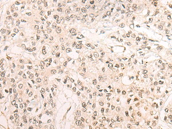 WEE1 Antibody - Immunohistochemistry of paraffin-embedded Human prost ate cancer tissue  using WEE1 Polyclonal Antibody at dilution of 1:35(×200)