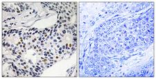 WEE1 Antibody - Immunohistochemistry analysis of paraffin-embedded human breast carcinoma, using WEE1 (Phospho-Ser53) Antibody. The picture on the right is blocked with the phospho peptide.