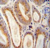 WFDC12 Antibody - WFDC12 antibody immunohistochemistry of formalin-fixed and paraffin-embedded human prostate carcinoma followed by peroxidase-conjugated secondary antibody and DAB staining.