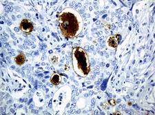 WFDC2 / HE4 Antibody - IHC of paraffin-embedded Adenocarcinoma of Human breast tissue using anti-WFDC2 mouse monoclonal antibody.