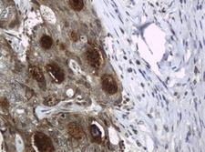 WFDC2 / HE4 Antibody - IHC of paraffin-embedded Adenocarcinoma of Human breast tissue using anti-WFDC2 mouse monoclonal antibody. (Heat-induced epitope retrieval by 10mM citric buffer, pH6.0, 120°C for 3min).