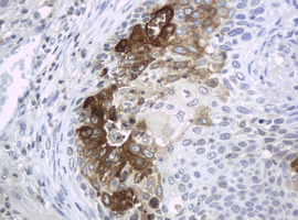 WFDC2 / HE4 Antibody - IHC of paraffin-embedded Carcinoma of Human lung tissue using anti-WFDC2 mouse monoclonal antibody. (Heat-induced epitope retrieval by 10mM citric buffer, pH6.0, 120°C for 3min).
