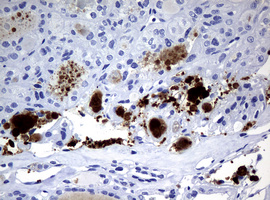 WFDC2 / HE4 Antibody - IHC of paraffin-embedded Carcinoma of Human thyroid tissue using anti-WFDC2 mouse monoclonal antibody. (Heat-induced epitope retrieval by 10mM citric buffer, pH6.0, 120°C for 3min).