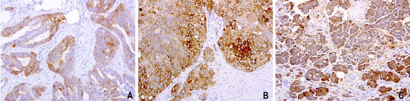 WFDC2 / HE4 Antibody - Immunohistochemical staining of paraffin-embedded 3 human ovarian cancer using anti-HE4 clone UMAB87 mouse monoclonal antibody at 1:200 dilution of 1.0 mg/mL using Polink2 Broad HRP DAB for detection.requires HIER with with citrate pH6.0 at 110C for 3 min using pressure chamber/cooker. The tumor cells show membrane and cytoplasmic staining.