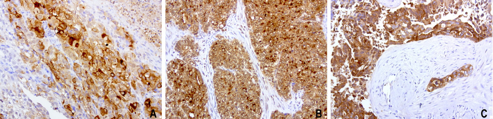 WFDC2 / HE4 Antibody - Immunohistochemical staining of paraffin-embedded 3 human endometrial cancer using anti-HE4 clone UMAB87 mouse monoclonal antibody at 1:200 dilution of 1.0 mg/mL using Polink2 Broad HRP DAB for detection.requires HIER with with citrate pH6.0 at 110C for 3 min using pressure chamber/cooker. The tumor cells show membrane and cytoplasmic staining.
