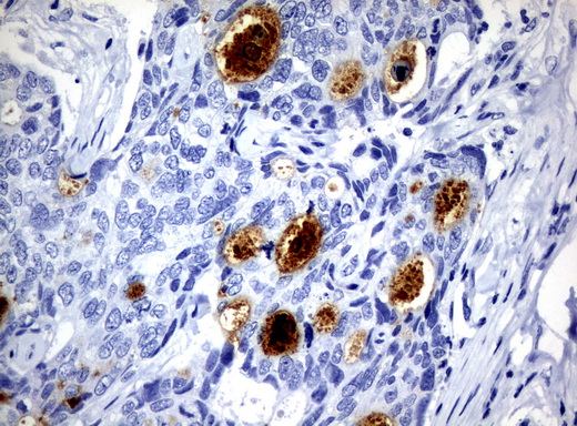WFDC2 / HE4 Antibody - Immunohistochemical staining of paraffin-embedded Adenocarcinoma of Human breast tissue using anti-WFDC2 mouse monoclonal antibody.  heat-induced epitope retrieval by 10mM citric buffer, pH6.0, 120C for 3min)