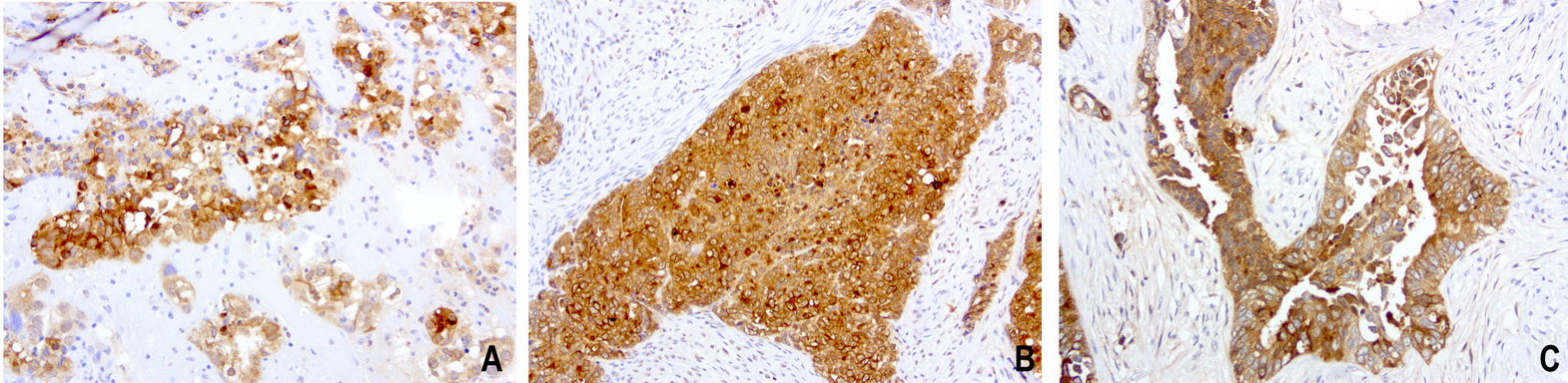 WFDC2 / HE4 Antibody - Immunohistochemical staining of paraffin-embedded 3 human endometrial cancer using anti-HE4 clone UMAB88 mouse monoclonal antibody at 1:200 dilution of 1.0 mg/mL using Polink2 Broad HRP DAB for detection.requires HIER with with citrate pH6.0 at 110C for 3 min using pressure chamber/cooker. The tumor cells show membrane and cytoplasmic staining.