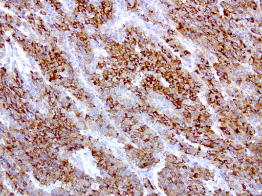 WFDC2 / HE4 Antibody - Immunohistochemical staining of paraffin-embedded human lung cancer using anti-HE4 clone UMAB88 mouse monoclonal antibody at 1:200 dilution of 1.0 mg/mL using Polink2 Broad HRP DAB for detection.requires HIER with with citrate pH6.0 at 110C for 3 min using pressure chamber/cooker. The tumor cells show membrane and cytoplasmic staining.
