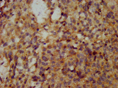 WFDC2 / HE4 Antibody - Immunohistochemistry of paraffin-embedded human ovarian cancer using WFDC2 Antibody at dilution of 1:100