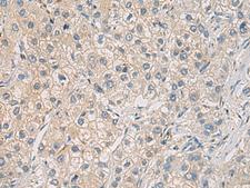 WFDC3 Antibody - Immunohistochemistry of paraffin-embedded Human liver cancer tissue  using WFDC3 Polyclonal Antibody at dilution of 1:40(×200)