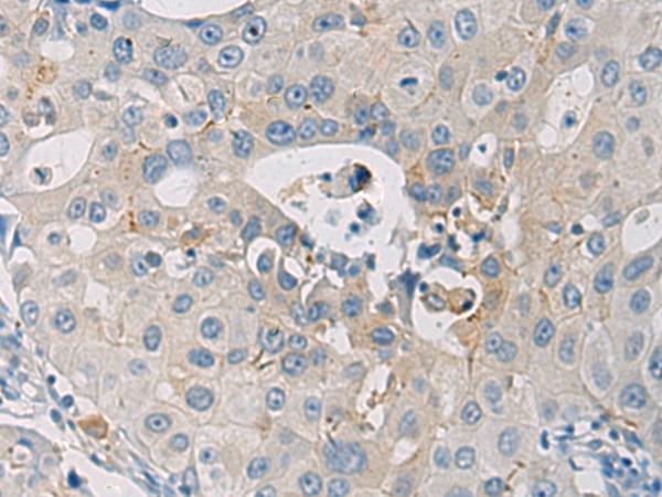 WFDC3 Antibody - Immunohistochemistry of paraffin-embedded Human breast cancer tissue  using WFDC3 Polyclonal Antibody at dilution of 1:40(×200)