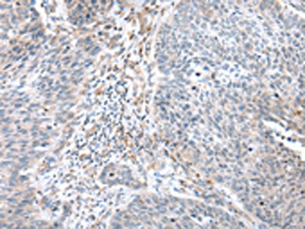 WFDC5 / PRG5 Antibody - Immunohistochemistry of paraffin-embedded Human lung cancer tissue  using WFDC5 Polyclonal Antibody at dilution of 1:60(×200)