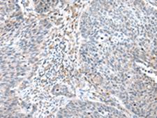 WFDC5 / PRG5 Antibody - Immunohistochemistry of paraffin-embedded Human lung cancer tissue  using WFDC5 Polyclonal Antibody at dilution of 1:60(×200)