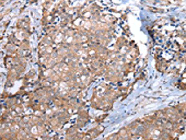 WFDC5 / PRG5 Antibody - Immunohistochemistry of paraffin-embedded Human breast cancer tissue  using WFDC5 Polyclonal Antibody at dilution of 1:60(×200)