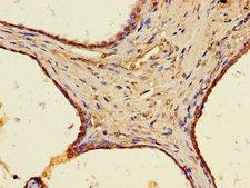 WFDC8 Antibody - Immunohistochemistry of paraffin-embedded human prostate cancer tissue using WFDC8 Antibody at dilution of 1:100